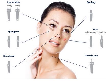 Agnes RF: Precision Skin Treatment for Facial Contouring,  Eye Bags and Acne.