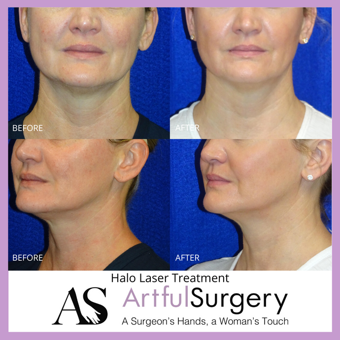 HALO vs. BBL -  Which treatment is right for you?